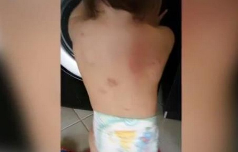 Момиченце се прибира от ясла нахапано по гърба (ВИДЕО)